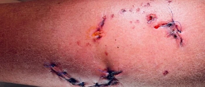 33 Nähte hatte der Mann am Unterschenkel und am Unterarm