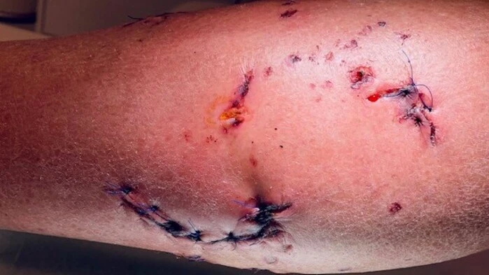 33 Nähte hatte der Völkermarkter am Unterschenkel und am Unterarm 