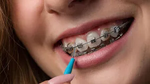 Die Gratis-Zahnspange erhalten nur Kinder mit schweren Fehlstellungen