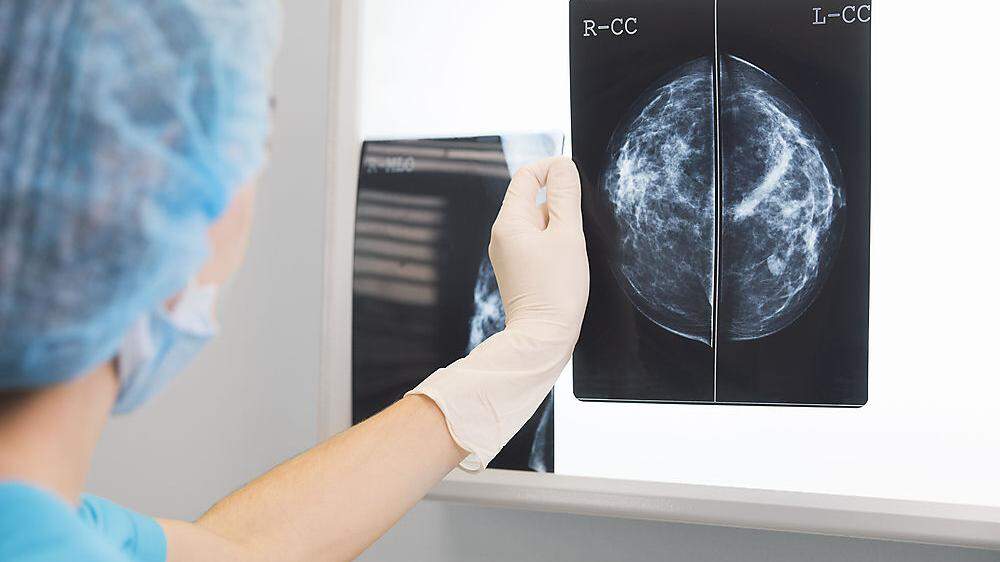 Dramatische Zahlen: 40 Prozent weniger Brustkrebsfälle entdeckt