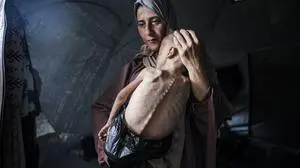 GAZA CITY, GAZA - JULY 21: Muhammad Zakariya Ayyoub al-Matouq, a 1.5-year-old child in Gaza City, Gaza, faces life-threatening malnutrition as the humanitarian situation worsens due to ongoing Israeli attacks and blockade, on July 21, 2025. Having dropped from 9 to 6 kilograms, he struggles to survive in a tent in Gaza City, where milk, food, and other basic necessities are lacking. (Photo by Ahmed Jihad Ibrahim Al-arini/Anadolu via Getty Images)