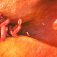 Ablagerungen (Plaques) haben bei Atherosklerose eine Verengung der Blutgefäße zur Folge. Ein wichtiger Risikofaktor sind erhöhte Cholesterinwerte.