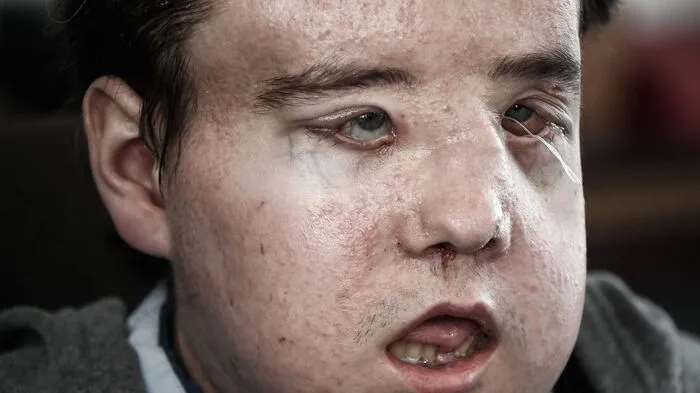 Jerome Hamon ist der erste Mann weltweit, der sich zwei Mal einer Gesichtstransplantation unterzogen hat. Das erste Gesicht wurde nach einer Erkältung von Hamons Körper abgestoßen.