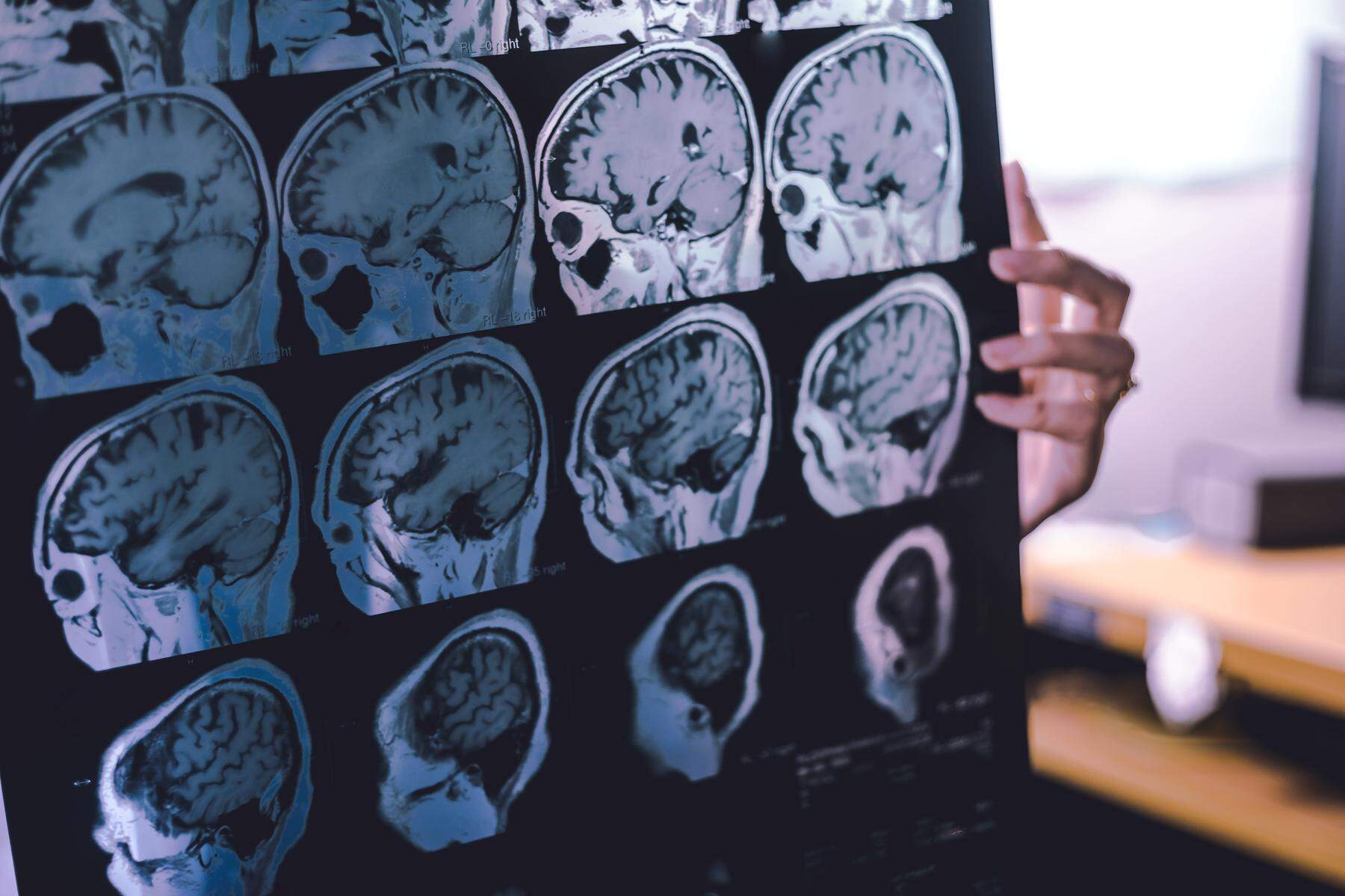 Keine Zulassung für Alzheimer-Wirkstoff: „Rückschlag für Patienten“ 