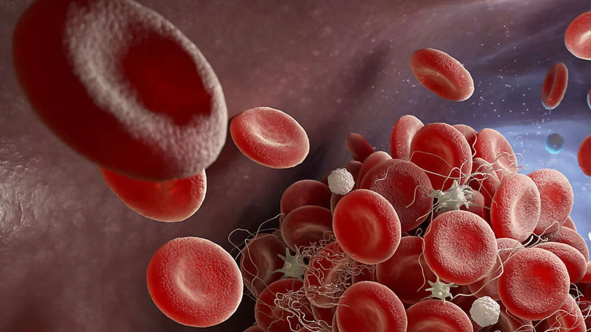 Bei schweren Covid-19-Verläufen kommt es häufig zu Gerinnungsproblemen