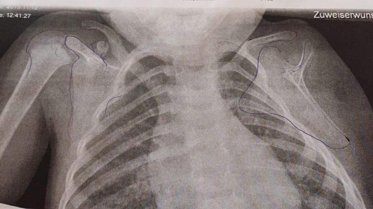 Auf dem Röntgenbild des Kindes ist die Fehlbildung an der linken Seite deutlich zu sehen