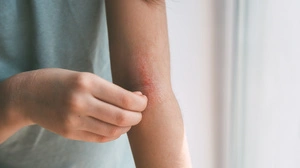 Nicht nur die Hautoberfläche sollte bei Neurodermitis behandelt werden, auch das Stresslevel sollte reguliert werden