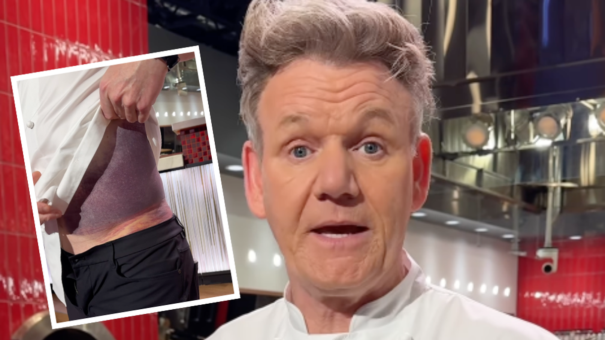 Star-Koch Gordon Ramsay zeigt seine Verletzungen auf Instagram
