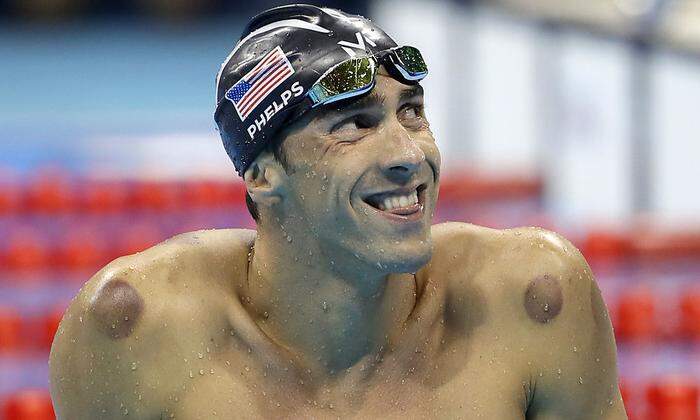 Typische Schröpfmale auf den Schultern von Michael Phelps