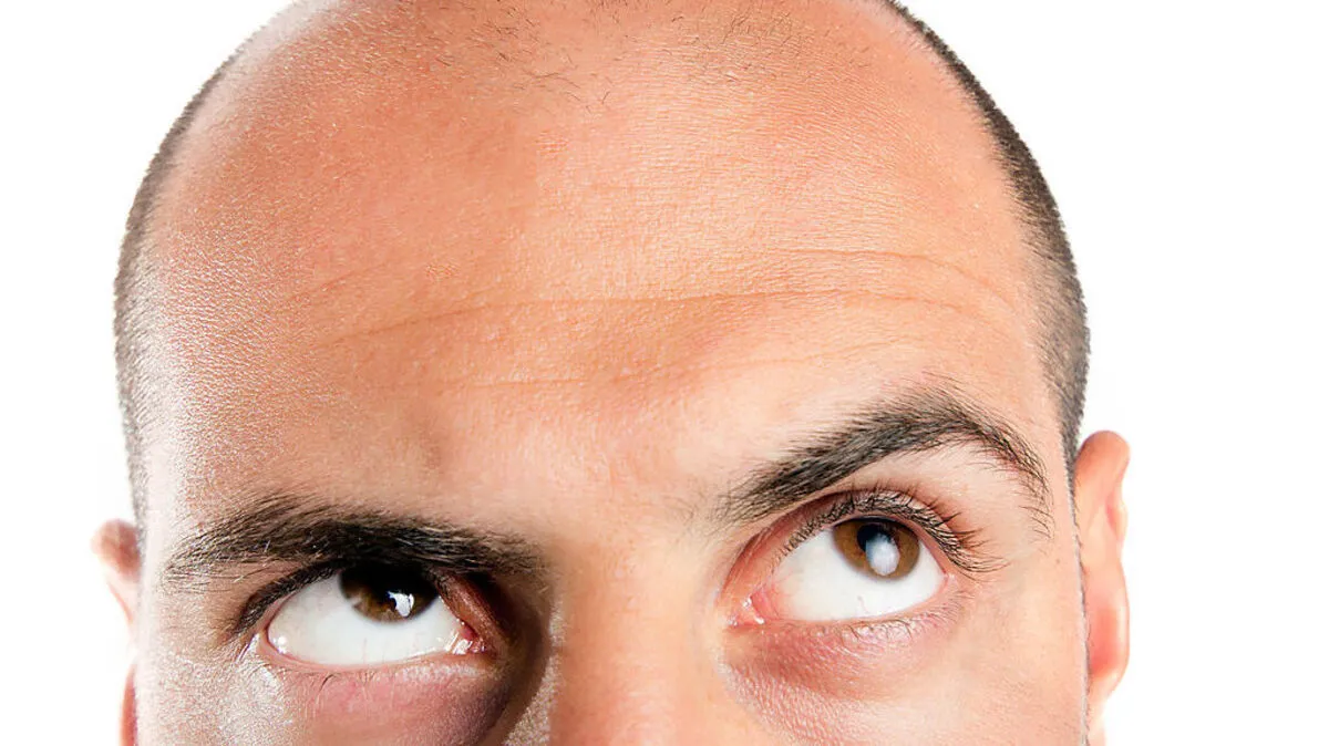 Kreisrunder Haarausfall: Was steckt dahinter?