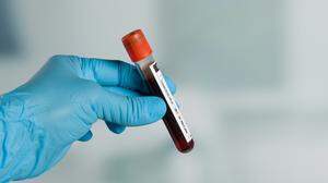 Noch gibt es keinen schnellen Test für die gefundenen Veränderungen im Blut