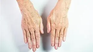 Altersflecken werden durch Sonneneinstrahlung verursacht