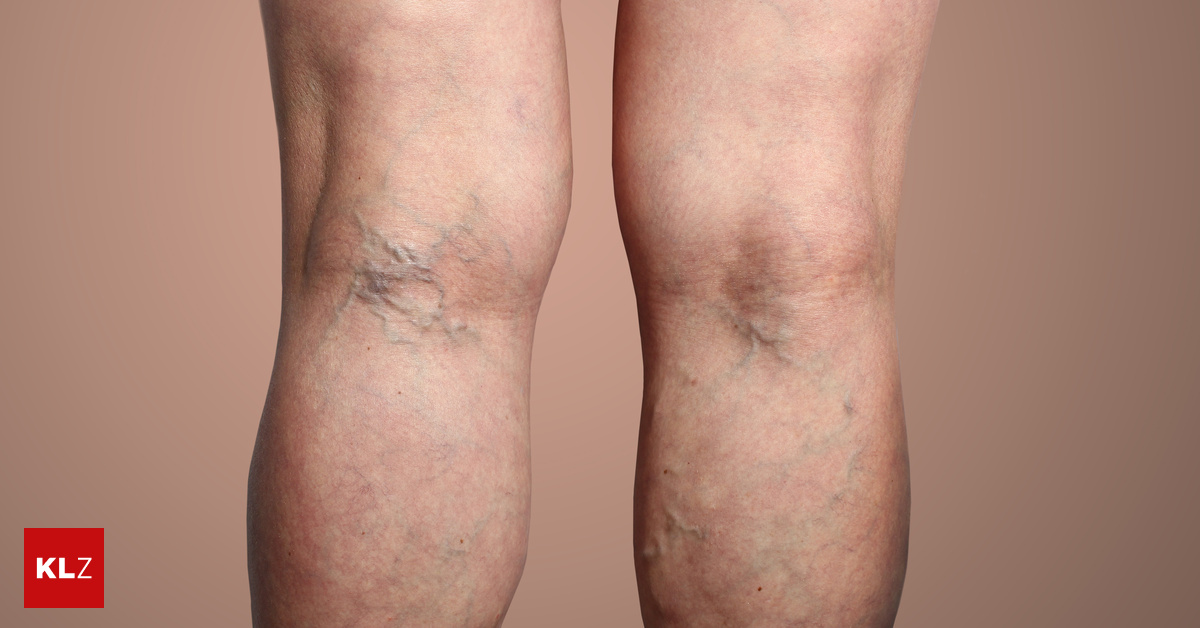 Causes and Symptoms of Varicose Veins