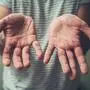 A young man is showing his hands with spots and rash from hand foot and mouth disease