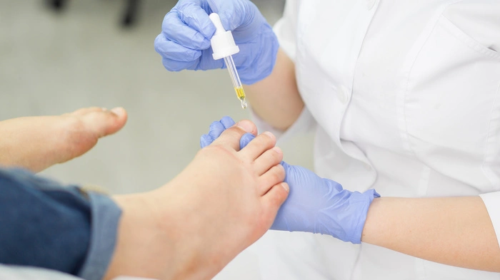 Besteht der Verdacht auf Nagelpilz, sollte man diesen ärztlich abklären lassen.