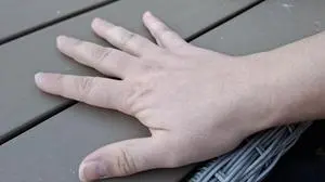 Eine Oststeirerin erzählt anonym über ihre psychischen Krankheiten, sie leidet unter anderem an einer dissoziativen Identitätsstörung  