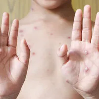 Affenpocken sind eng mit jenem Virus verwandt, das auch die echten Pocken auslöst