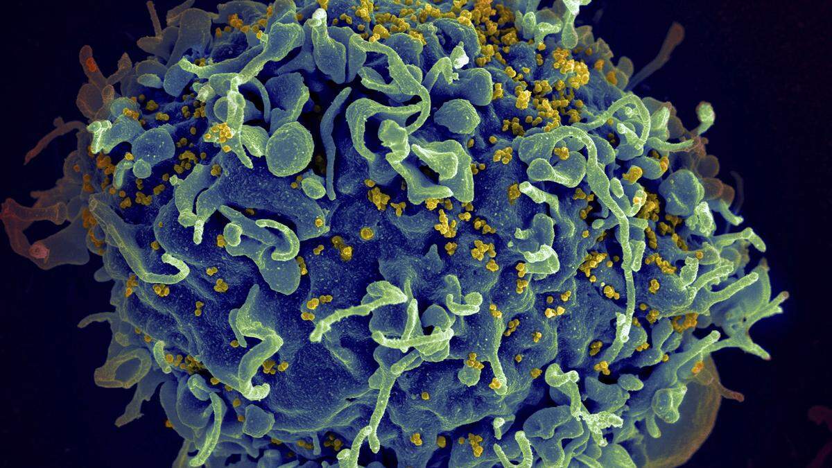 Eine menschliche T-Zelle (blau) wird von HI-Viren (gelb) attackiert.