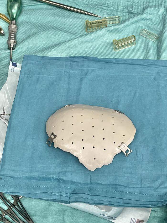 Dieses Modell wurde am 12. September bei einer 59-minütigen Operation eingesetzt. Zu sehen sind die Plättchen, über die das Implantat mit der Schädeldecke verschraubt wurde, und die Löcher durch die die Hirnhaut mit dem Implantat vernäht wurde.