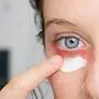 Eine Frau behandelt eine Rötung unter dem Auge mit einer Salbe | Wegen einer Rötung unter dem Auge wurde der Patientin eine Augensalbe verschrieben. Die Kasse übernimmt die Kosten aber nur bei einem Augenarzt-Rezept (Symbolbild)
