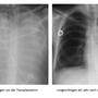 Die Lunge der Kärntnerin vor der Operation (links) und danach