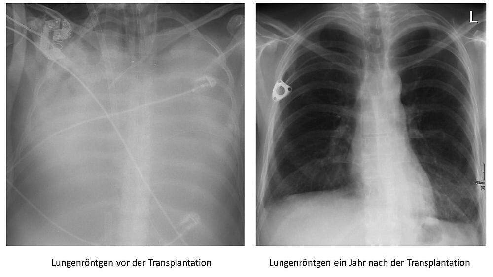 Die Lunge der Kärntnerin vor der Operation (links) und danach