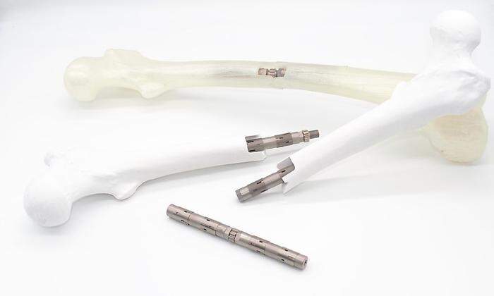 Das "Bone Compression Dowel" wird in das Knocheninnere implantiert und verbindet zwei Bruchstücke miteinander