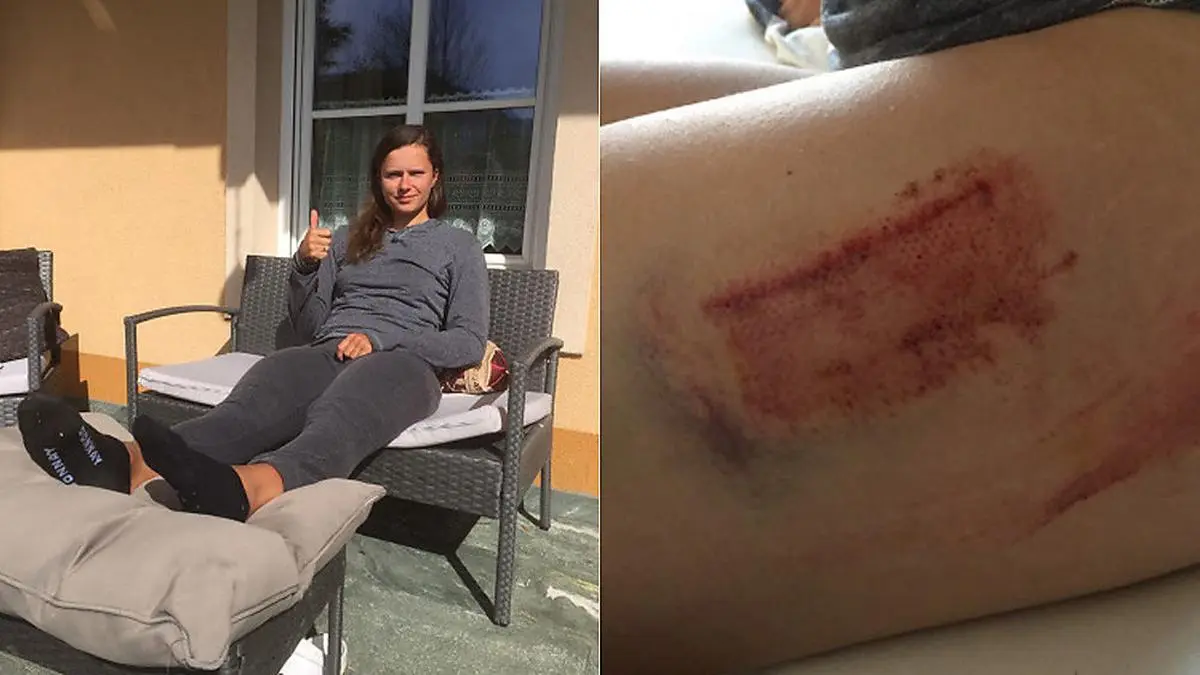 Vanessa Herzog erholt sich zur Zeit daheim in Unterferlach, die blauen Flecken sind am ganzen Körper verteilt 