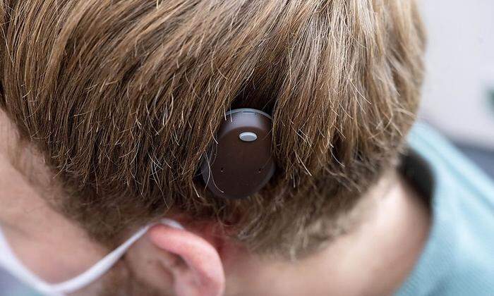 Der äußere Teil des Hörimplantats hängt durch Magneten am implantierten Teil, der unter der Haut liegt