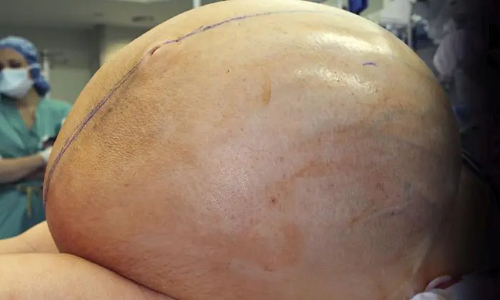 In this February 2018 photograph provided by the Danbury Hospital, a large tumor is prepared to be removed from a patient at the hospital in Danbury, Conn. Doctors removed the 132-pound tumor from a woman's abdomen, and she is expected to recover fully. The ovarian tumor was diagnosed after the 38-year-old woman reported rapid weight gain of about 10 pounds per week over a two-month period. (Danbury, Conn. Hospital via AP)