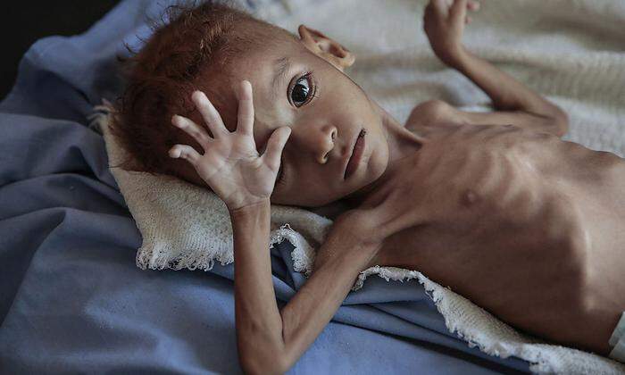 Cholera: Im Bürgerkriegsland Jemen forderte die Seuche mehr als 2300 Opfer.