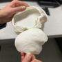 Diese Schädeldecke aus dem 3D-Drucker wurde dem zehnjährigen Felix in Salzburg eingesetzt 
