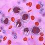 Ist man an Leukämie erkrankt, produziert der Körper keine gesunden, sondern entartete Blutzellen.
