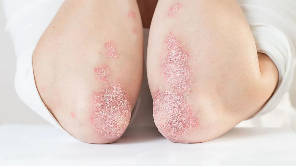 "Einen vielversprechenden therapeutischen Ansatz zur Behandlung für Psoriasis" nennen die Wissenschafter ihre Forschungsergebnis