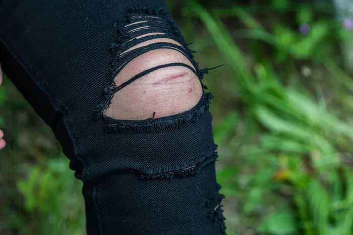 Die Spuren der OP am linken Knie. Aber: "Wenn es danach geht, hätte ich schon als Kind keine kurzen Hosen mehr tragen dürfen. Meine Knie waren immer aufgeschunden!"