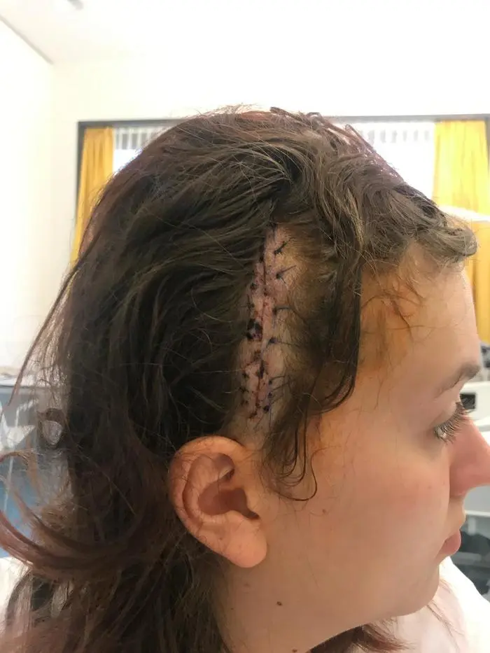 Die Operationsnarbe von Christina Obrekar