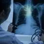 Doctor hand point patient lung x-ray film before treatment for diagnosis pneumonia, pulmonary tuberculosis, Mers-CoV, SARS or Covid-15.Medical treatment concept.