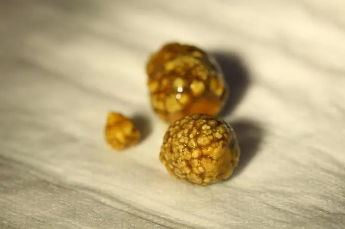 Am 11.05.2011 treffen sich Dr. Frank P. Mueller, Dr. Markus Wittenberg, Dr. Thomas Lerchenbach mit WAZ-Redakteur Friedhelm Potthoff zu einem Vorgespraech zum WAZ-Forum mit dem Thema Galle im Marien-Hospital in Gelsenkirchen Buer. Im Bild: Gallensteine. Foto: Thomas Goedde / WAZ FotoPool