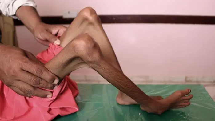 Weltweit leiden rund 673 Millionen Menschen an Hunger