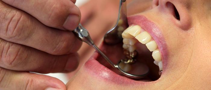 Künftig darf Amalgam für Zahnfüllungen nicht mehr verwendet werden