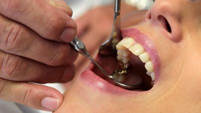 Künftig darf Amalgam für Zahnfüllungen nicht mehr verwendet werden