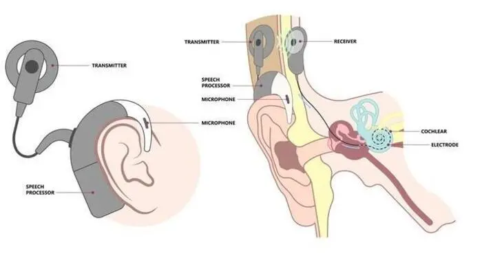 So funktioniert ein Cochlea-Implantat