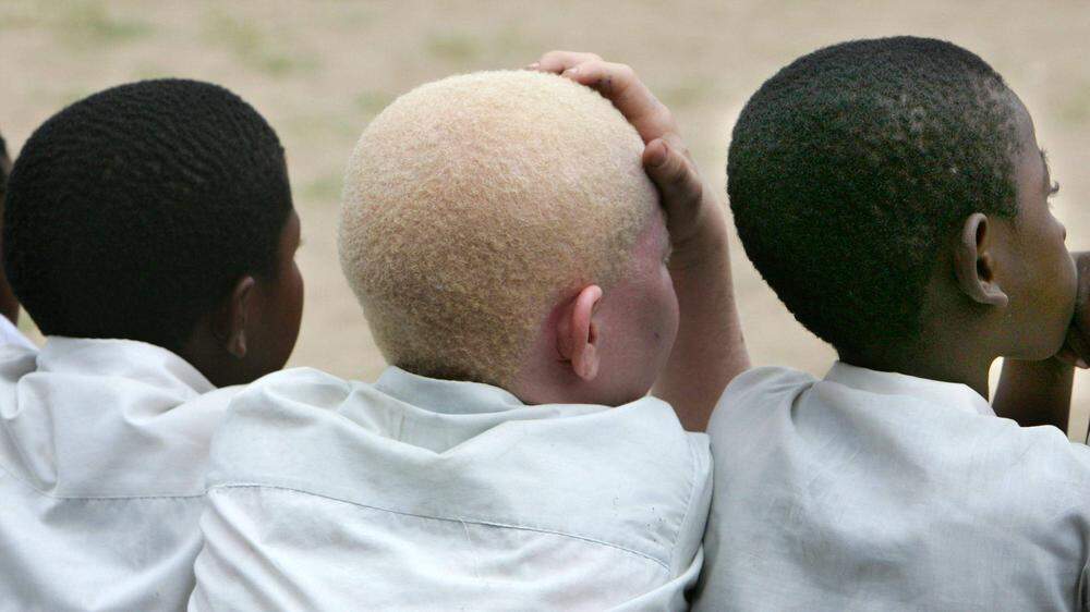 In einigen afrikanischen Ländern werden aus rituellen Gründen immer wieder Albino-Menschen entführt, weil ihren hellen Körpern magische Kräfte nachgesagt werden