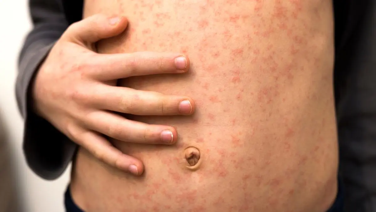 Der für die Masern charakteristische Ausschlag tritt etwa drei bis sieben Tage nach den ersten Krankheitssymptomen auf. Schon einige Tage davor sind Betroffene ansteckend