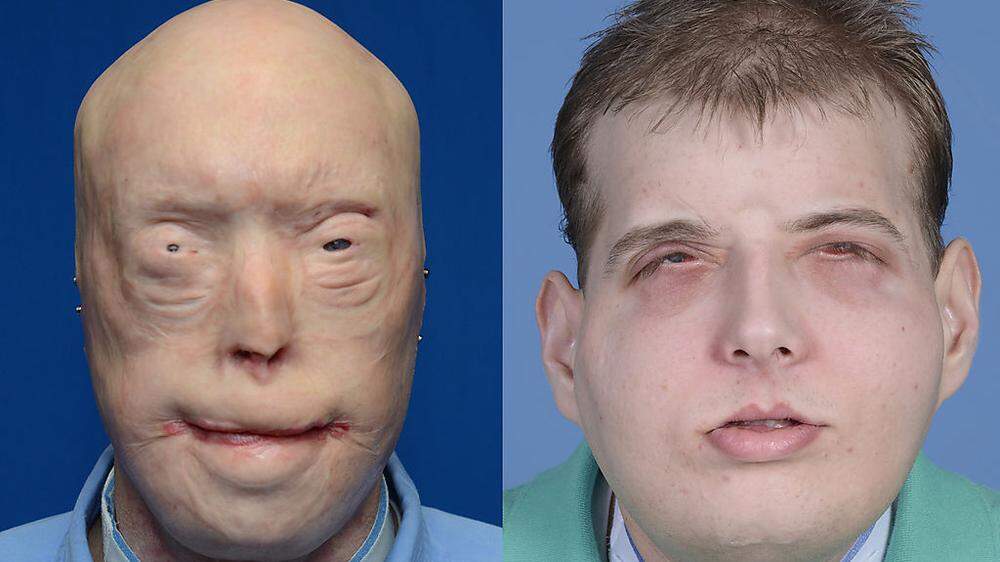 Patrick Hardison vor und nach der Gesichtstransplantation