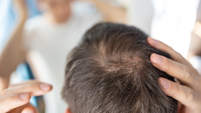 Altersglatze und Geheimratsecken: Koffeinhaltige Shampoos versprechen, diesen entgegenzuwirken. Wissenschaftliche Belege für dieses Versprechen fehlen allerdings.