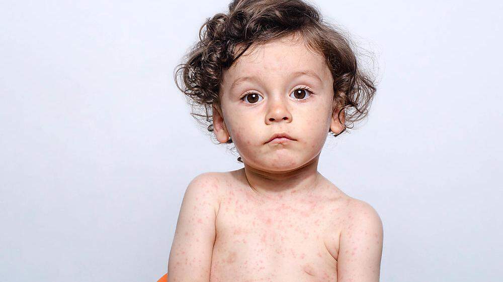 Kindern ohne Impfschutz drohen ernsthafte Probleme