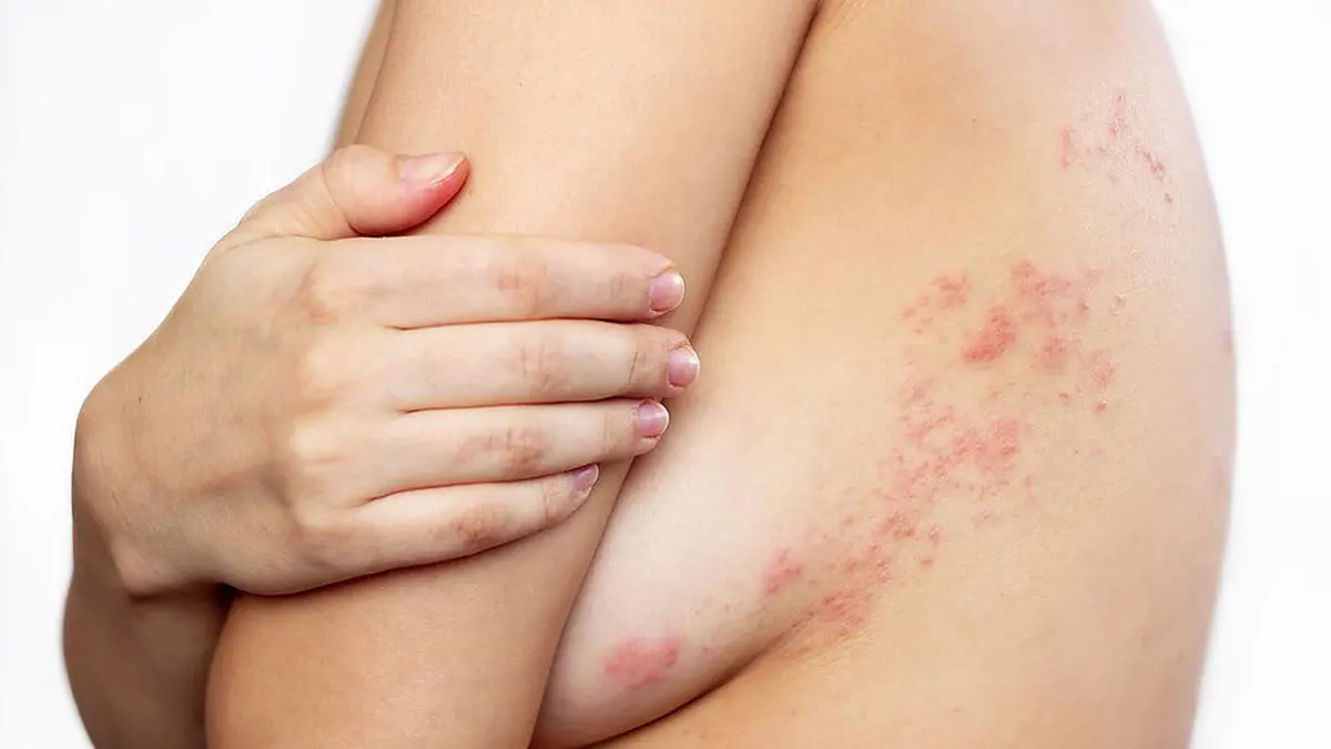 Bläschenbildung am Oberkörper ist für die Gürtelrose typisch.