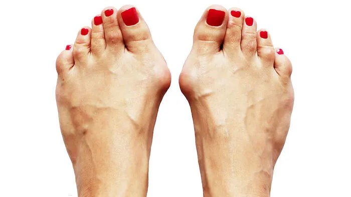Halux valgus