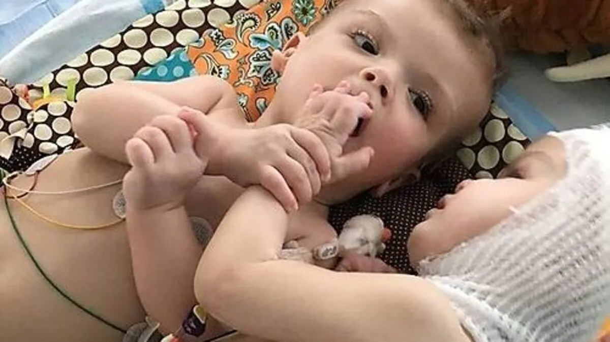 Jaden und Anias (rechts) nach der Operation